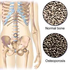 osteoporosis_locations