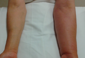 lymphedema-2